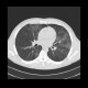 Intraalveolar hemorrhage, case 2: CT - Computed tomography